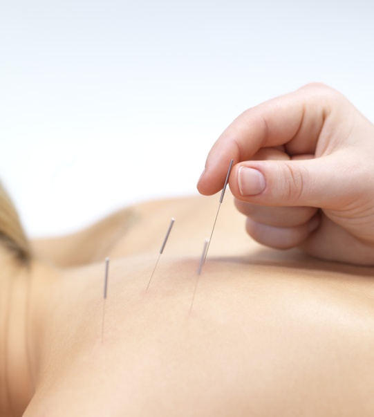 acupuncture médecines douces médecines alternatives